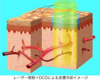 DCD＋レーザー作用イメージ