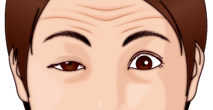 眼瞼下垂症-三白眼イラスト